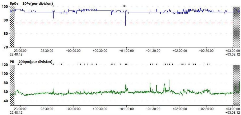 My graph, first part of the night, with sleep appliance