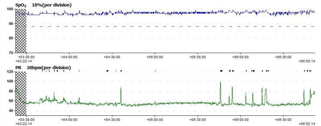 My graph, second part of the night, without sleep appliance