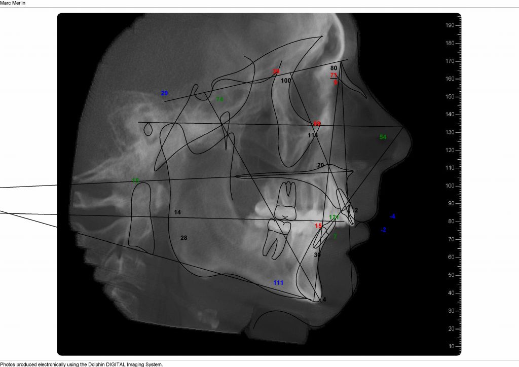 does show that my upper teeth were way in front of the bottom ones (not because of the teeth as much as the jaw).