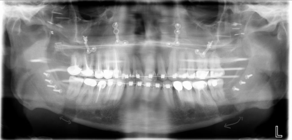 after (check the arrows showing where and by how much the bottom jaw was cut and moved)